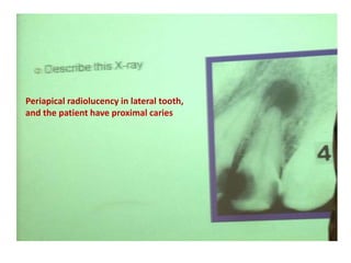 Periapical radiolucency in lateral tooth,
and the patient have proximal caries
 