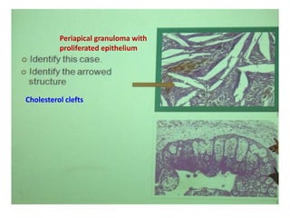 Periapical granuloma with
proliferated epithelium
Cholesterol clefts
 