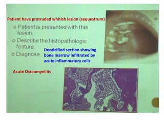 Patient have protruded whitish lesion (sequestrum)
Decalcified section showing
bone marrow infiltrated by
acute inflammatory cells
Acute Osteomyelitis
 