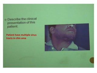 Patient have multiple sinus
tracts in chin area
 