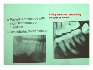 Radiopaque area surrounding
the apex of lower 6
 