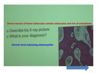 Dense masses of bone trabeculae contain osteocytes and rim of osteoblasts
Chronic focal sclerosing osteomyelitis
 
