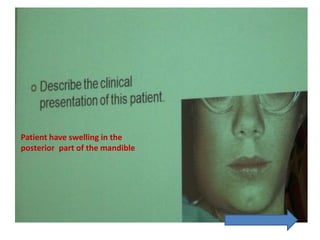 Patient have swelling in the
part of the mandibleposterior
 