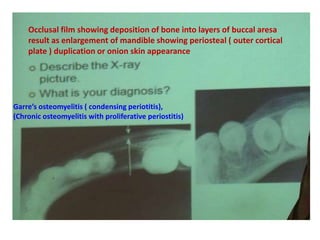 Occlusal film showing deposition of bone into layers of buccal aresa
result as enlargement of mandible showing periosteal ( outer cortical
plate ) duplication or onion skin appearance
Garre’s osteomyelitis ( condensing periotitis),
(Chronic osteomyelitis with proliferative periostitis)
 