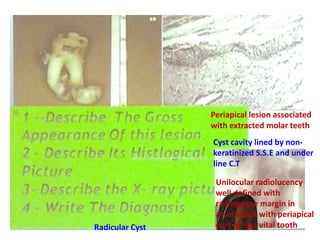 Periapical lesion associated
with extracted molar teeth
Cyst cavity lined by non-
keratinized S.S.E and under
line C.T
Unilocular radiolucency
well defined with
radiopaque margin in
association with periapical
part of non vital toothRadicular Cyst
 