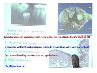 Extracted canine in association with cystic lesion, the cyst attached to the tooth at CEJ
Unilocular well defined periapical lesion in association with unerupted tooth
Cyst cavity lined by non-keratinized epithelium
Dentigenous cyst
 