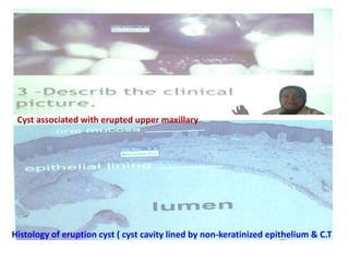Cyst associated with erupted upper maxillary
Histology of eruption cyst ( cyst cavity lined by non-keratinized epithelium & C.T
 