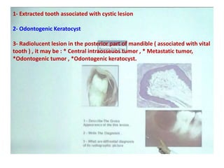 1- Extracted tooth associated with cystic lesion
2- Odontogenic Keratocyst
3- Radiolucent lesion in the posterior part of mandible ( associated with vital
tooth ) , it may be : * Central intraosseuos tumor , * Metastatic tumor,
*Odontogenic tumor , *Odontogenic keratocyst.
 