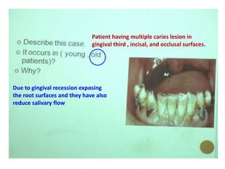 Patient having multiple caries lesion in
gingival third , incisal, and occlusal surfaces.
Due to gingival recession exposing
the root surfaces and they have also
reduce salivary flow
 