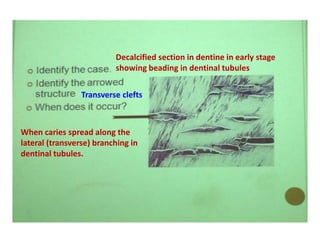 Decalcified section in dentine in early stage
showing beading in dentinal tubules
Transverse clefts
When caries spread along the
lateral (transverse) branching in
dentinal tubules.
 