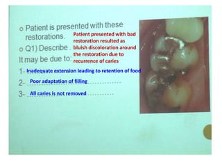 Patient presented with bad
restoration resulted as
bluish discoloration around
the restoration due to
recurrence of caries
Inadequate extension leading to retention of food
Poor adaptation of filling
All caries is not removed
 