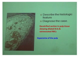 Decalcified section in pulp tissue
showing dilated B.Vs &
extravasated RBCs
Hyperemia of the pulp
 