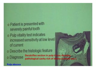 Decalcifies section in pulp tissue showing
pathological cavity rich of debris (contain pus )
Pulp abscess
 
