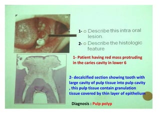 1-
2-
1- Patient having red mass protruding
in the caries cavity in lower 6
2- decalcified section showing tooth with
large cavity of pulp tissue into pulp cavity
, this pulp tissue contain granulation
tissue covered by thin layer of epithelium
Diagnosis : Pulp polyp
 