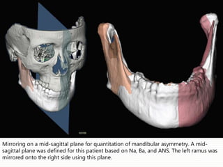 Mirroring on a mid-sagittal plane for quantitation of mandibular asymmetry. A mid-
sagittal plane was defined for this patient based on Na, Ba, and ANS. The left ramus was
mirrored onto the right side using this plane.
 