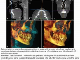 Determination of anterior boundary conditions in a case with severely retroclined maxillary and
mandibular incisors using sagittal (A), axial (B) and coronal (C) multiplanar, and 3D volumetric (D
and E) reconstructions.
a severe Class II division 2 malocclusion presents with upper incisor roots that have
limited buccal bone support that could be placed into a better relationship with the bone
 