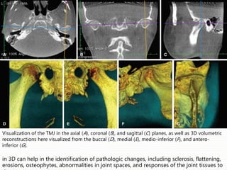 Visualization of the TMJ in the axial (A), coronal (B), and sagittal (C) planes, as well as 3D volumetric
reconstructions here visualized from the buccal (D), medial (E), medio-inferior (F), and antero-
inferior (G).
in 3D can help in the identification of pathologic changes, including sclerosis, ﬂattening,
erosions, osteophytes, abnormalities in joint spaces, and responses of the joint tissues to
 