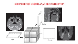SECONDARY OR MULTIPLANAR RECONSTRUCTION
 