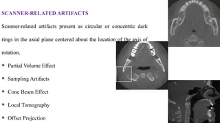 SCANNER-RELATED ARTIFACTS
Scanner-related artifacts present as circular or concentric dark
rings in the axial plane centered about the location of the axis of
rotation.
⁕ Partial Volume Effect
⁕ Sampling Artifacts
⁕ Cone Beam Effect
⁕ Local Tomography
⁕ Offset Projection
 