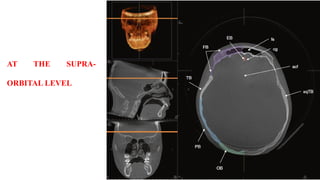 AT THE SUPRA-
ORBITAL LEVEL
 