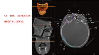 AT THE SUPERIOR-
ORBITAL LEVEL
 