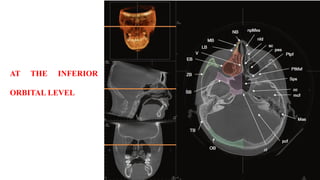 AT THE INFERIOR
ORBITAL LEVEL
 