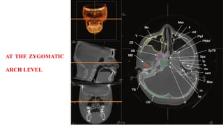 AT THE ZYGOMATIC
ARCH LEVEL
 
