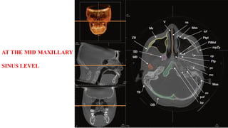 AT THE MID MAXILLARY
SINUS LEVEL
 