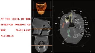 AT THE LEVEL OF THE
SUPERIOR PORTION OF
THE MAXILLARY
ALVEOLUS
 