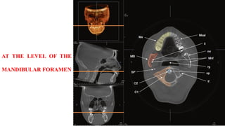 AT THE LEVEL OF THE
MANDIBULAR FORAMEN
 