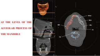 AT THE LEVEL OF THE
ALVEOLAR PROCESS OF
THE MANDIBLE
 