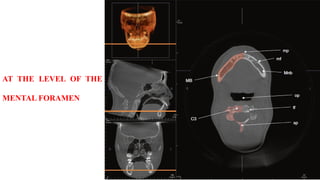 AT THE LEVEL OF THE
MENTAL FORAMEN
 