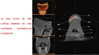 AT THE LEVEL OF THE
LOWER BORDER OF THE
ANTERIOR MANDIBULAR
SYMPHYSIS
 