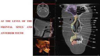 AT THE LEVEL OF THE
FRONTAL SINUS AND
ANTERIOR TEETH
 