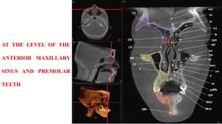 AT THE LEVEL OF THE
ANTERIOR MAXILLARY
SINUS AND PREMOLAR
TEETH
 