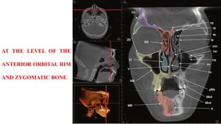 AT THE LEVEL OF THE
ANTERIOR ORBITAL RIM
AND ZYGOMATIC BONE
 