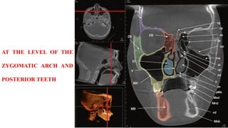 AT THE LEVEL OF THE
ZYGOMATIC ARCH AND
POSTERIOR TEETH
 