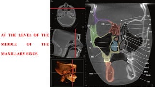 AT THE LEVEL OF THE
MIDDLE OF THE
MAXILLARY SINUS
 