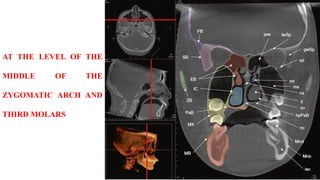 AT THE LEVEL OF THE
MIDDLE OF THE
ZYGOMATIC ARCH AND
THIRD MOLARS
 