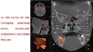 AT THE LEVEL OF THE
ANTERIOR SPHENOID
SINUS, MAXILLARY
TUBEROSITY AND THIRD
MOLARS
 