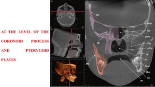 AT THE LEVEL OF THE
CORONOID PROCESS
AND PTERYGOID
PLATES
 