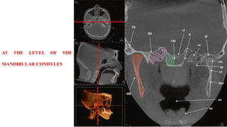 AT THE LEVEL OF THE
MANDIBULAR CONDYLES
 