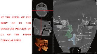 AT THE LEVEL OF THE
BODY OF C1 AND
ODONTOID PROCESS OF
C2 OF THE UPPER
CERVICAL SPINE
 