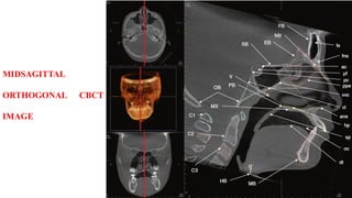 MIDSAGITTAL
ORTHOGONAL CBCT
IMAGE
 