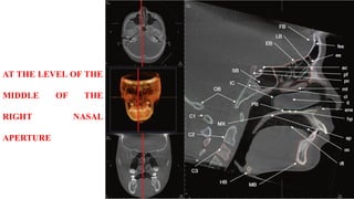 AT THE LEVEL OF THE
MIDDLE OF THE
RIGHT NASAL
APERTURE
 