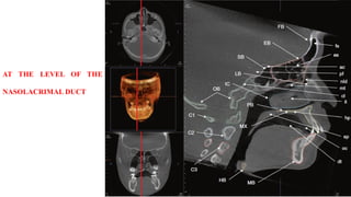AT THE LEVEL OF THE
NASOLACRIMAL DUCT
 