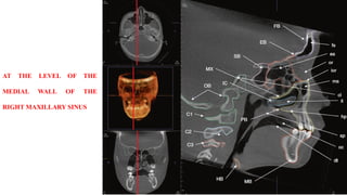 AT THE LEVEL OF THE
MEDIAL WALL OF THE
RIGHT MAXILLARY SINUS
 