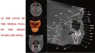 AT THE LEVEL OF
THE MEDIAL WALL
OF THE RIGHT
MAXILLARY SINUS
 