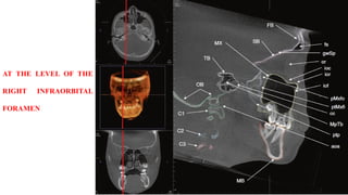AT THE LEVEL OF THE
RIGHT INFRAORBITAL
FORAMEN
 