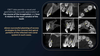 CBCT in Endodontics, Uses, Advanatges, Disadvantages, and Recent ...
